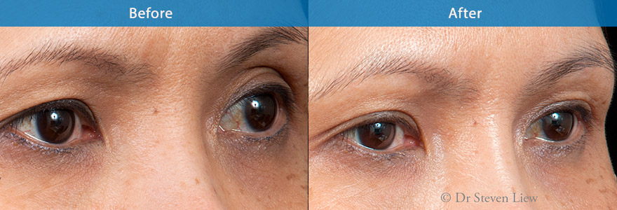 <h3>Case 4</h3><p>This lady shows aging to her eyebrows. The eyebrows looks deflated with slight drooping of the eyelid skin.</p><p>Dermal filler was used to plump up the eyebrow, resulting in a brighter eye appearance. The eyebrows look more useful and more projected. The excess skin in the upper eyelids has also been lifted.</p>