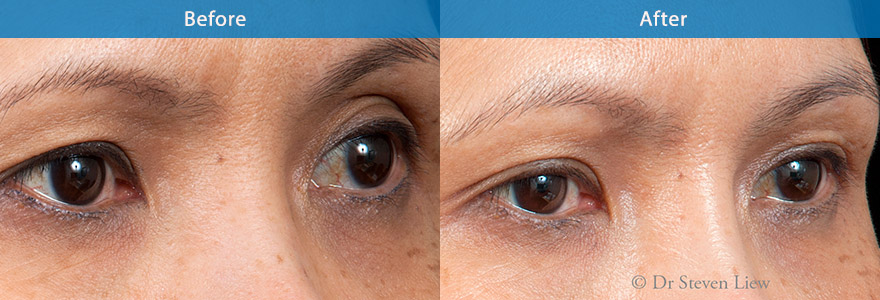 <h3>Case 5</h3><p>58 year old Asian lady complains of droopy eyelids. She is not ready for eyelid surgery.</p><p>Dermal filler was used to plump up the eyebrow, resulting in a brighter eye appearance. The eyebrows look more useful and more projected. The excess skin in the upper eyelids has  also been lifted.</p>