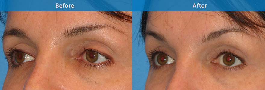 <h3>Case 6</h3><p>43 year old lady underwent eyebrow lifting with the use of antiwrinkle injections.</p>