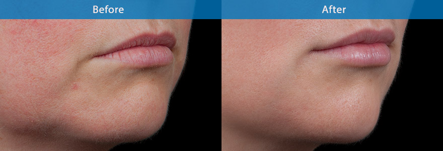 <h3>Case 1</h3><p>This 42 year old lady showed early signs of aging of her mouth . She looked sad with the down turn corner of mouth.</p><p>Dermal filler was used to uplift the corner of the mouth, with the reminder of filler to enhance the fullness of her lips.</p>