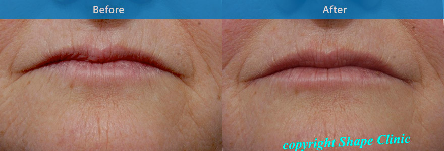 <h3>Case 2</h3><p>This 42 year old lady showed early signs of aging of her mouth . She looked sad with the down turn corner of mouth.</p><p>Dermal filler was used to uplift the corner of the mouth, with the reminder of filler to enhance the fullness of her lips.</p>