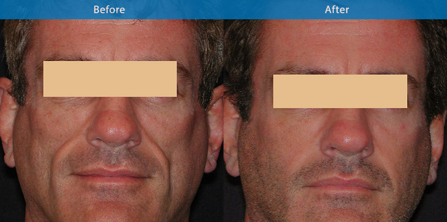 <h3>Case 1</h3><p>This gentleman has a condition termed facial lipoatrohy which can be associated with certain illness, creating  tired and gaunt like features. Specialised dermal filler was used on a yearly basis to restore the fullness and maintaining a natural and healthy appearance</p>