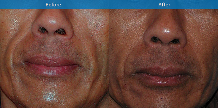 <h3>Case 2</h3><p>This gentleman has a condition termed facial lipoatrohy which can be associated with certain illness, creating  tired and gaunt like features. Specialised dermal filler was used  on a yearly basis to restore the fullness and maintaining a natural and healthy appearance</p>