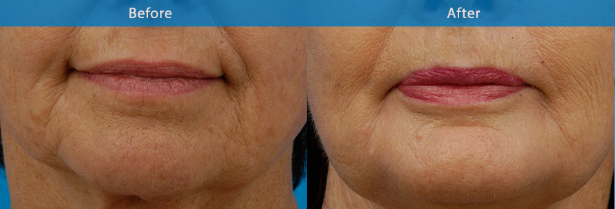 <h3>Case 1</h3><p>A 57 year old patient, very self conscious about her lower facial appearance. Her main concern was the marionette lines and deep folds in the corners of her mouth which made her appear unhappy. </p><p>She also suffered from occasional dermatitis which is common for patients with deep skin folds around the mouth.</p><p>While the patient is contemplating lower face and necklift surgery, in the interim she opted for a non surgical enhancement with dermal fillers. This has softened the deep folds around her mouth, significantly improving her appearance.</p>