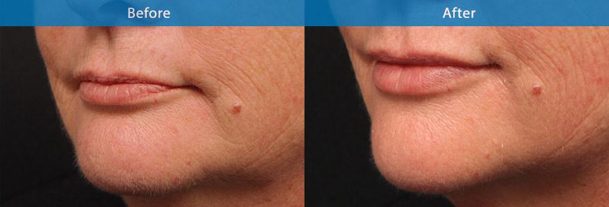 <h3>Case 2</h3><p>A 59 year old patient, appears sad with  down turning of the corner of her lips.</p><p>Dermal fillers were placed in the corner of her mouth and her top and bottom lips, creating a nicer, naturally looking age appropriate lips. The sad down turning lips have also been uplifted.</p>