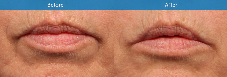 <h3>Case 3</h3><p>A 58 female with down turning and aging lips. Dermal filler was placed in the corner of the lips to uplift the lip, creating a brighter, happier and more youthful lips.</p>