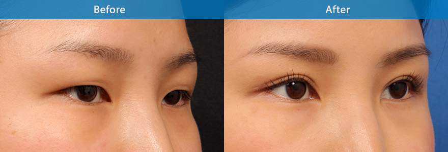 <h3>Case 1</h3><p>Asian  “double- eyelid” surgery</p><p>A young Asian lady requesting a bigger eye. An open incision technique was used , creating a crisp parallel  crease at an aesthetically appropriate level for this lady.  The after result has transformed the eyes from that of a small and puffy appearance to that of a fresh and brighter eyes.</p>