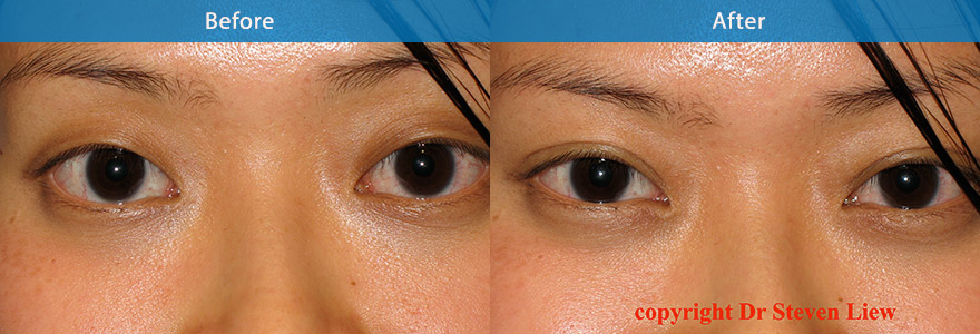 <h3>Case 2</h3><p>“An open incision technique to create a “ lateral flare” and “ outer” shape eyelid crease”. A 28 Asian patient who found it impossible to apply eye shadow due to the lack of definition in her upper eyelid crease. This was surgically corrected, giving her eyes a more alluring appearance by creating a crisp and well defined eyelid crease. Downtime : 7 to 10 days</p>