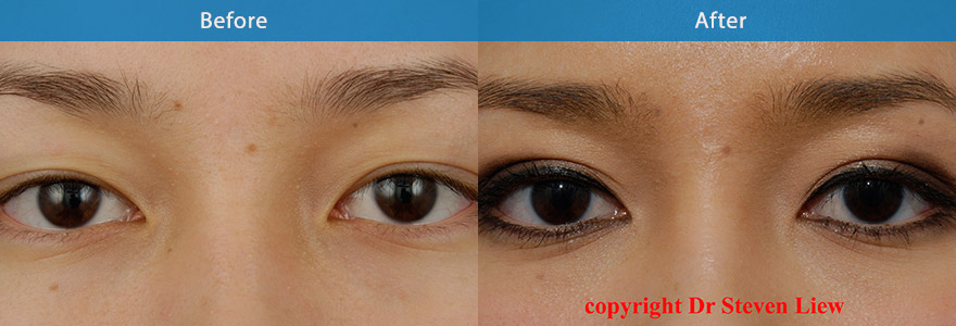 <h3>Case 3</h3><p>An open incision technique to create a “ lateral flare” shape eyelid crease.  The creative use of make up further enhanced her exotic eyelid appearance.</p>