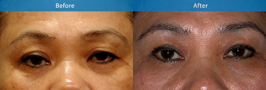 <h3>Case 4</h3><p>An open incision technique to remove excess skin and create a crisp eyelid crease in a mature Asian lady.</p>