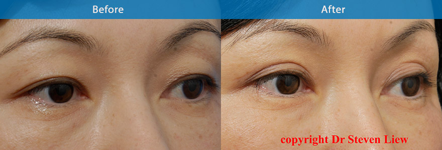 <h3>Case 5</h3><p>An open incision technique to increase the height of the eyelid crease and create a “ parallel” and “ outer”  shape eyelid crease</p>