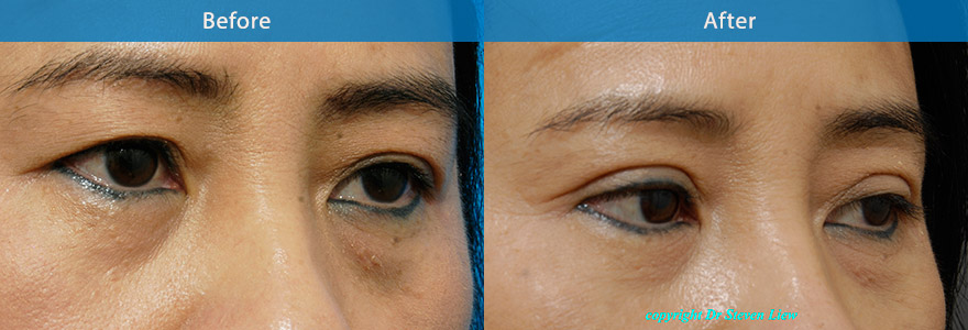 <h3>Case 6</h3><p>An open incision technique to remove excess skin and create a crisp eyelid crease.</p>
