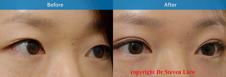 <h3>Case 7</h3><p>An open incision technique to create a “ lateral flare” shape eyelid crease</p>