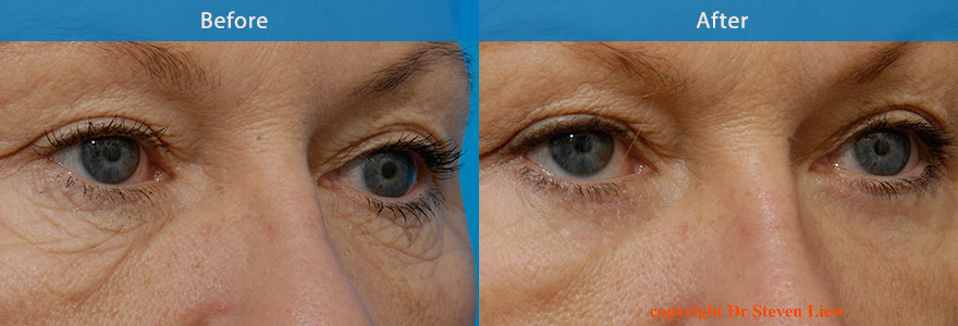 <h3>Case 1</h3><p>Middle age lady with loose and crepe skin under her eyes. A lower eyelift is performed to remove the loose skin and tighten the lower eyelid with no noticeable scar under her eyelashes.</p>