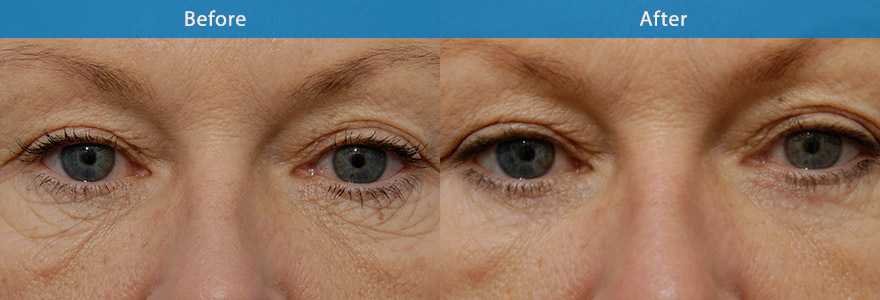 <h3>Case 2</h3><p>Middle age lady with loose and crepe skin under her eyes. A lower eyelift is performed to remove the loose skin and tighten the lower eyelid with no noticeable scar under her eyelashes.</p>