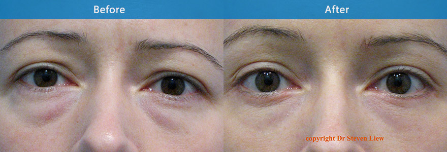 <h3>Case 3</h3><p>Young lady with asymmetrical eyebrow and heaviness of the upper eyelid and fatty bulges to lower eyelid. She looked  tired. A keyhole browlift surgery  and lower eyelid fat reduction ( transconjunctival/ from inner eyelid)  created a more refreshed appearance.</p>