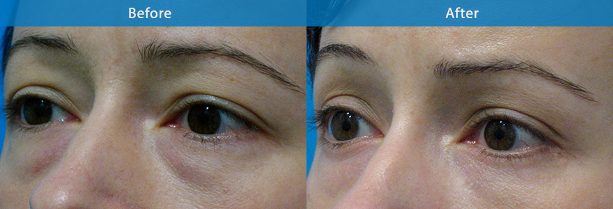 <h3>Case 4</h3><p>Young lady with asymmetrical eyebrow and heaviness of the upper eyelid and fatty bulges to lower eyelid. She looked  tired. A keyhole browlift surgery  and lower eyelid fat reduction ( transconjunctival/ from inner eyelid)  created a brighter eye and  refreshed appearance. </p>