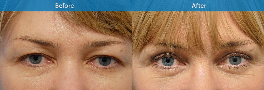 <h3>Case 1</h3><p>A upper eyelift and brow fixation surgery was performed to create a sharp and crisp eyelid crease and brighten her eye appearance</p>