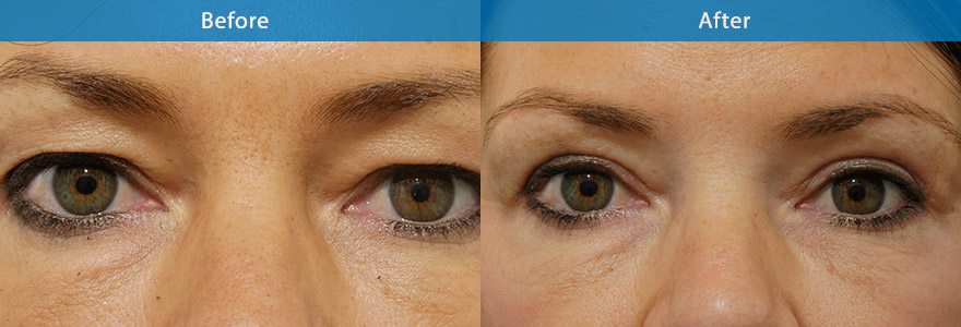 <h3>Case 2</h3><p>A upper eyelift and brow fixation surgery was performed to create a sharp and crisp eyelid crease and brighten her eye appearance</p>