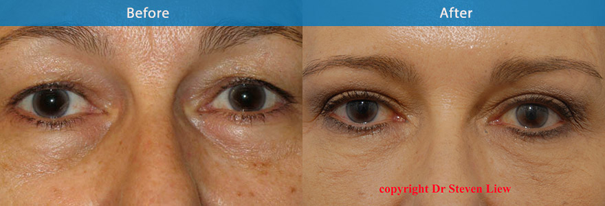 <h3>Case 3</h3><p>A upper eyelift and brow fixation surgery was performed to create a sharp and crisp eyelid crease and brighten her eye appearance. She is not ready for lower eyelid surgery. Hence a nonsurgical lower eyelift was performed with filler, which will last her from 2 to 4 years.</p>