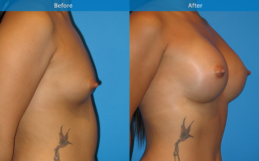 <h3>Case 10</h3><p><strong>Patient details:</strong></p><p>27 Asian female, like to increase her breast from A to C cup. Like to have “significant fullness on top”. Love to wear cocktail dresses without taping or bra.</p><p><strong>Surgical Plan</strong></p><p>This lady has thick and nonpliable skin on her chest typical of many Asian patients. She is of 5 feet 2 in height. The key in successful augmentation for her is to enhance the breasts to harmonise her body. A breast that is too full and too wide for her body will make her look top heavy and disharmonise her body shape.</p><p>The aim is to beautify her breasts and harmonise her whole body and Not make her look “ fat “. Sadly, this is a fairly common results seen in the communities for those petite females and their surgeons, whom in the quest of achieving certain breast size had lost sight of balancing and harmonising the patient’s overall appearance.</p><p><strong>Result:</strong></p><p>A 300 gm round implant placed subfascial, resulted in full, voluptuous D cup breasts that fit her body shape and gives the illusion of a slimmer waist and upper body.</p>