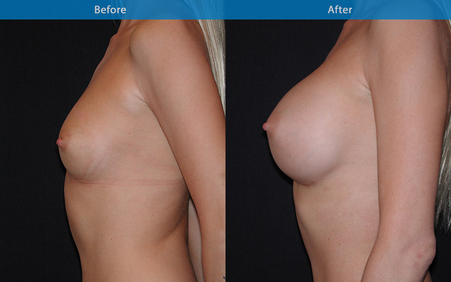 <h3>Case 11</h3><p><strong>Patient details:</strong></p><p>Aged 30, requesting fuller breast. “ Like them be quite large, and full on top and D cup”, does not mind if they are “ fake looking “</p><p><strong>Surgical Plan</strong></p><p>375gm round implant to widen and increase the projection of the breast from B to D cup, with extra fullness as requested.</p>