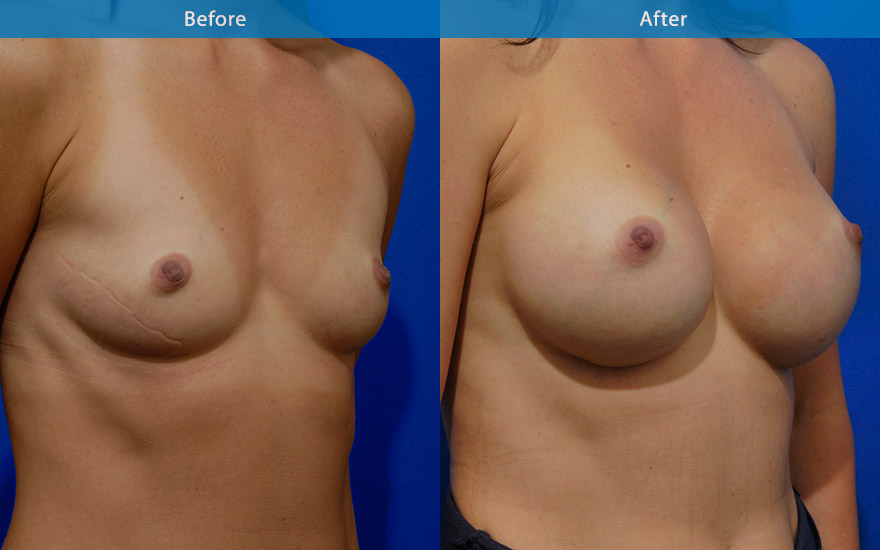 <h3>Case 4</h3><p>36 F requested a large proportionate breast enlargement from A to large D cup with round implant as requested to match her 172 cm frame.</p>