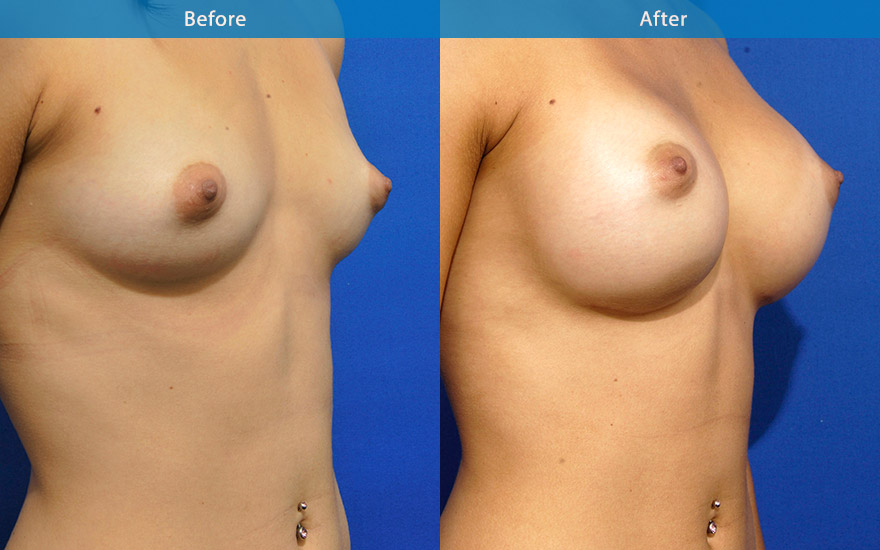 <h3>Case 5</h3><p><strong>Patient details:</strong></p><p>27F, 170 cm height with athletic body frame, requesting full and round breasts that fit her height.</p><p><strong>Surgical Plan</strong></p><p>400 gm moderate profile implants were chosen to provide the width and height to her new breasts. The result,full D cup breasts that complement her 170 cm frame.</p>