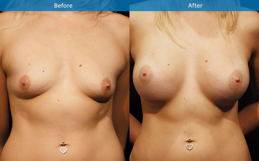 <h3>Case 6</h3><p>26 year old lady, with a fairly well formed breast tissue requesting a large proportionate enlargement with more fullness to the upper pole of the breasts. A 400gm high profile round implant placed under the muscle, to create a beautiful full D cup breast as requested.</p>