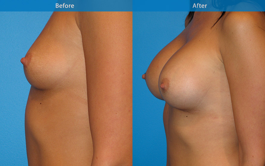 <h3>Case 7</h3><p><strong>Patient details:</strong></p><p>Aged 30 , 5 feet 11 inches (177cm) requesting fuller breast. “ Like them to be very perky, full on the top and size that matches her full height”. I am sick of wearing push –up bra.</p><p><strong>Surgical Plan</strong></p><p>425gm high profile round implants were used behind the muscle to create the look requested. B to DD cup. This matches her height of 177 cm. The after photo showing the extra fullness she had requested to match that of a push up bra look.</p>