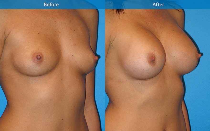 <h3>Case 7</h3><p><strong>Patient details:</strong></p><p>Aged 30 , 5 feet 11 inches (177cm) requesting fuller breast. “ Like them to be very perky, full on the top and size that matches her full height”. I am sick of wearing push –up bra.</p><p><strong>Surgical Plan</strong></p><p>425gm high profile round implants were used behind the muscle to create the look requested. B to DD cup. This matches her height of 177 cm. The after photo showing the extra fullness she had requested to match that of a push up bra look.</p>