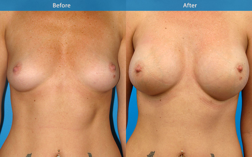<h3>Case 8</h3><p>38F requested large proportionate enhancement that will accommodate her frame. She has a height of 178cm. “I never want to wear a push-up bra again”: Wonder-bra look.</p><p>600gm round high profile implant were chosen and placed under the muscle to create proportionate large enhancement DD cup breasts, creating the fullness as requested.</p>
