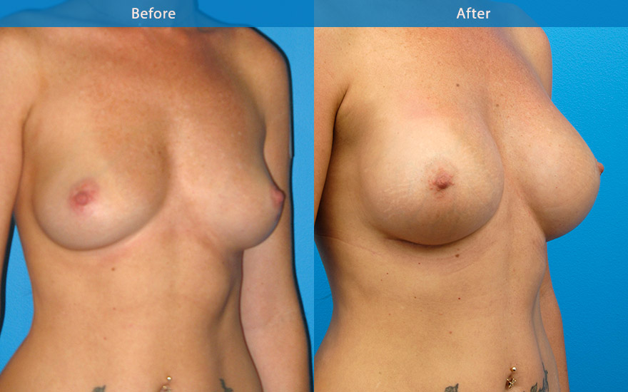 <h3>Case 8</h3><p>38F requested large proportionate enhancement that will accommodate her frame. She has a height of 178cm. “I never want to wear a push-up bra again”: Wonder-bra look.</p><p>600gm round high profile implant were chosen and placed under the muscle to create proportionate large enhancement DD cup breasts, creating the fullness as requested.</p>