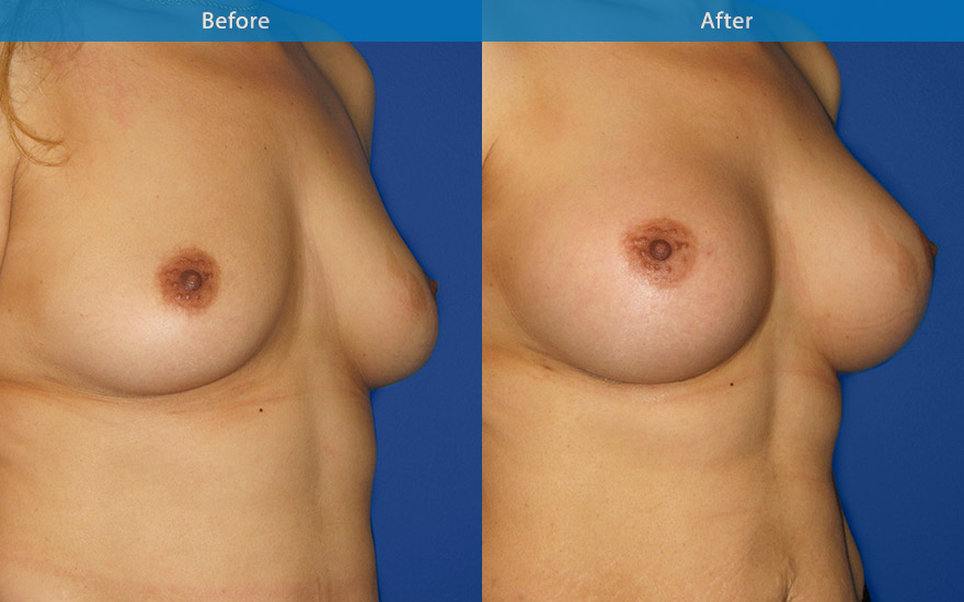 <h3>Case 9</h3><p>38 F requested a large proportionate breast enlargement but without the excessive upper pole fullness. Soft high profile round implants used to create full D cup breasts to match her 170 cm frame.</p>