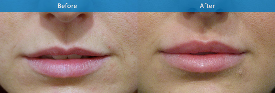 <h3>Case 1</h3><p>28 year old female who wanted more fullness to her upper lip. A soft filler was used to give more volume to upper lip as well as a slight pout to lower lip. The result is  a softer, more sensuous, juicy looking lips. </p><p>Duration : 8 to 12 months.</p>