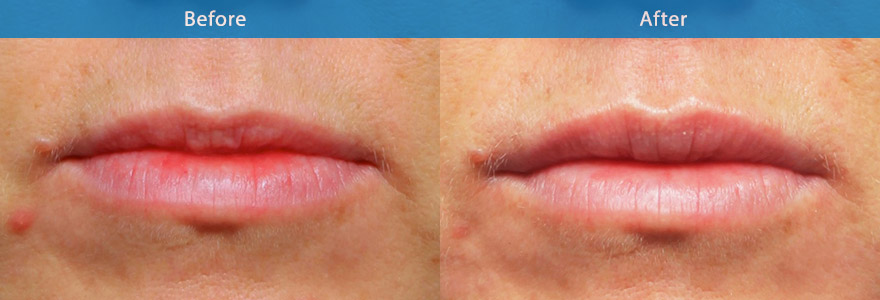 <h3>Case 2</h3><p>39  year old female who wanted more defined lips. A soft filler was used to give more  definition to the border of the lip and the Cupid’s bow a slight pout to lower lip. The result is  a softer, better defined, more sensuous, juicy looking lips. </p><p>Duration : 8 to 12 months. </p>