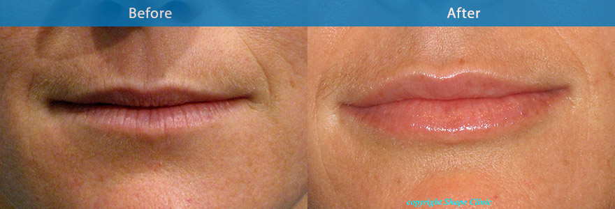 <h3>Case 3</h3><p>A 31 year old patient who has never worn lipstick because of her thin lips which have become progressively thinner with time.  Wanted her lips plumped but had been fearful of  the “ duck lips” or “trout pout” effect – the result of overtreatment treatment by practitioners with little aesthetic skill.</p><p>She was thrilled (and deeply relieved) by the results of Dr Liew’s lip enhancement which produced soft and natural looking lips.</p><p>Duration : 8 to 12 months. </p>