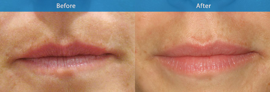 <h3>Case 4</h3><p>40  year old female who wanted more defined lips. A soft filler was used to give a conservative  and natural enhancement to the top and bottom lips The result is  a softer, better defined, more sensuous, juicy looking lips. </p><p>Duration : 8 to 12 months.</p>