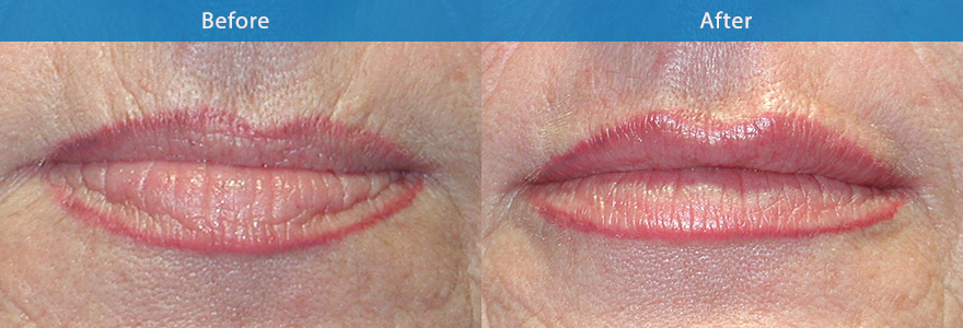 <h3>Case 5</h3><p>A life long smoker, this  52 year old patient resorted to lip tattooing in an attempt to give her lips definition.  But her lips are dry, depleted of fullness and the upper lips have multiple smoker’s lines and have lost their youthful definition.</p><p>A non surgical lip enhancement with soft dermal fillers restored lip definition, creating fuller, more hydrated lips and softening the lines on the upper lip.</p>