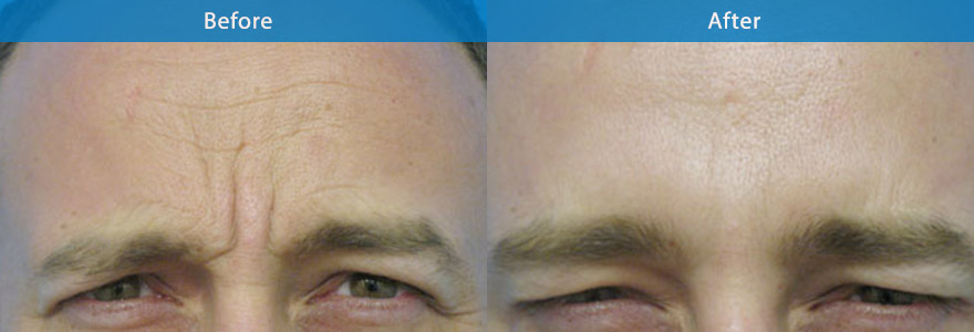 <h3>Case 1</h3><p>Antiwrinkle  injection to soften the frown lines and prevent deterioration of the forehead fold.</p>
