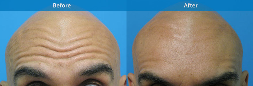 <h3>Case 2</h3><p>Judicious use of antiwrinkle  injection to soften the forehead lines and still allow normal brow elevation.</p>