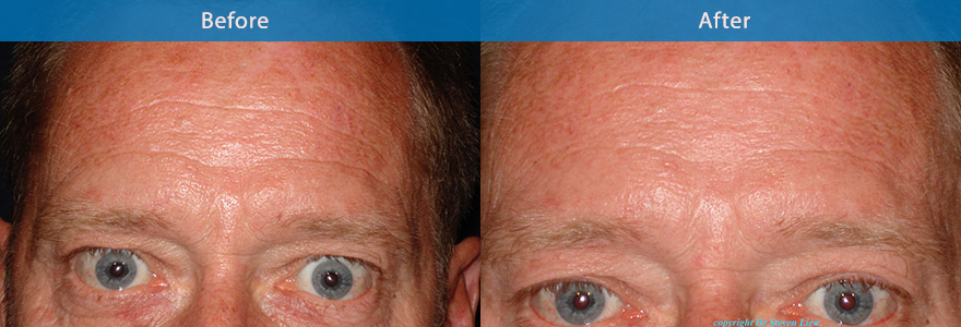 <h3>Case 3</h3><p>This gentleman would like to soften his forehead lines. On review, he had resting lines which was  made worse when he elevated his eyebrow. He also had excessive eyelid skin with a low eyebrow. The challenge here was  to Not  drop his eyebrow which can potentially worsen his droopy eyelids. Solution, Btx injections were placed evenly and superficially on his forehead to soften his lines as requested withour affecting his eyebrow position. He can still elevates his eyebrow naturally. </p>