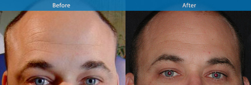 <h3>Case 4</h3><p>This gentleman would like to soften his forehead lines. On review, he had resting lines which was  made worse when he elevated his eyebrow. He also had excessive eyelid skin with a low eyebrow. The challenge here was  to Not  drop his eyebrow which can potentially worsen his droopy eyelids. Solution, Btx injections were placed evenly and superficially on his forehead to soften his lines as requested withour affecting his eyebrow position. He can still elevates his eyebrow naturally.</p>