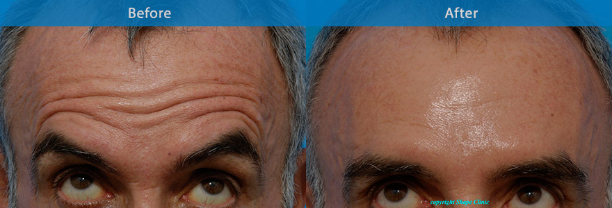 <h3>Case 5</h3><p>Anti-wrinkle  injection to soften the forehead wrinkles and still allow normal brow elevation.</p>