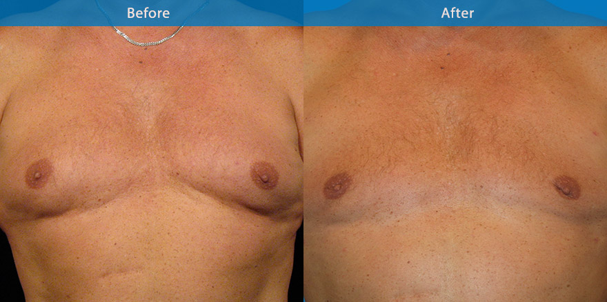 <h3>Case 1</h3><p>Vaser Liposelection ( advanced liposculpting technique with ultrasonic energy) was performed on this man gynaecomastia (man boob) to create a more manly chest appearance without any  incision on the breast.</p>