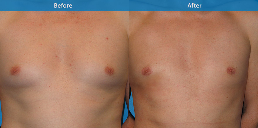 <h3>Case 2</h3><p>A almost invisible half moon shaped incision was used to excise the thick breast tissue from this man. The result at 6 weeks showed a flatter male chest appearance.</p>