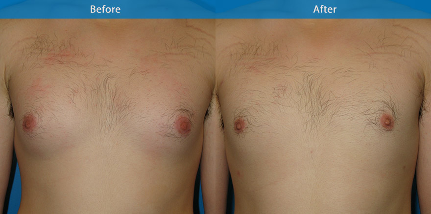 <h3>Case 3</h3><p>Vaser Liposelection ( advanced liposculpting technique with ultrasonic energy) was performed on this man gynaecomastia (man boob) to create a well defined  male’s chest without any  incision on the breast.</p>