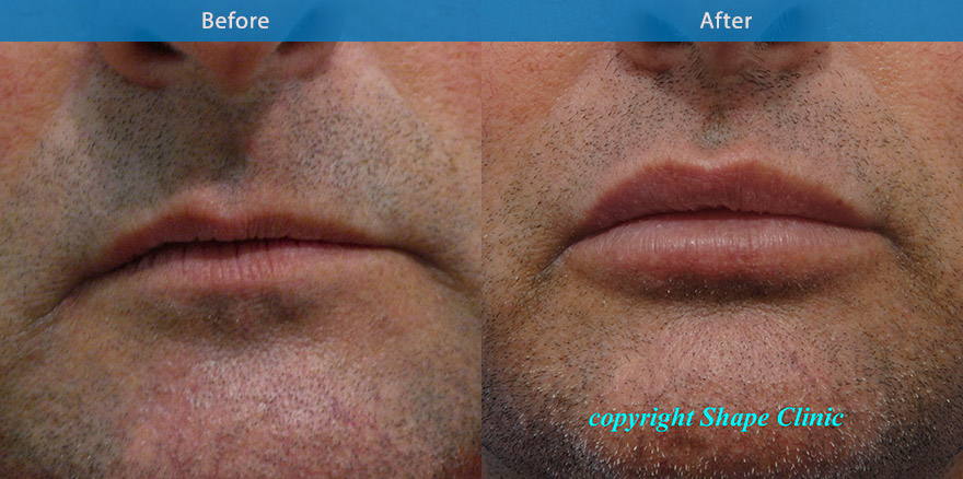 <h3>Case 1</h3><p>This man felt that his lips were extremely crooked and has become thinner with aging. Dermal filler was used to restore the youthful fullness and balance as well as improving the crookedness.</p>