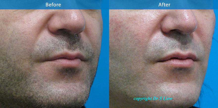 <h3>Case 2</h3><p>Soft gel dermal filler was used to restore hollowing in this man’s cheek. Following this simple procedure patient appears naturally refreshed and healthier.</p>