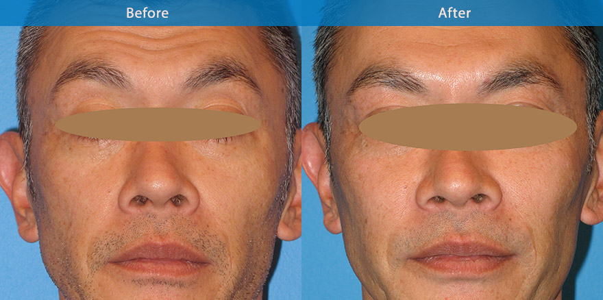 <h3>Case 3</h3><p>This male patient appeared haggard and old due to loss of fullness to his cheek following a stressful period.  Anti-wrinkle injections to the forehead and dermal filler to restore fullness to the cheek made him look younger and healthier. Longevity : 15 -18 months</p>